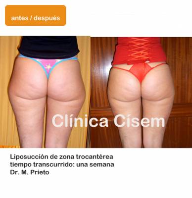 Liposucci�n de cartucheras